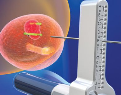 Biopsja fuzyjna prostaty – nowoczesna technika diagnostyczna nowotworu gruczołu krokowego w Szpitalu na Klinach