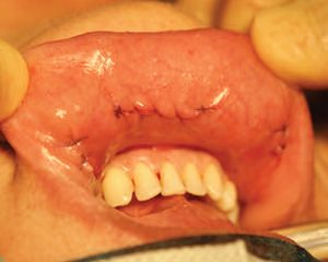 endoskopowa operacja tarczycy metoda toetva