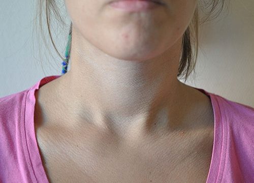 Endoskopowa operacja tarczycy metodą TOETVA 5