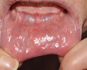 endoskopowa operacja tarczycy metoda toetva