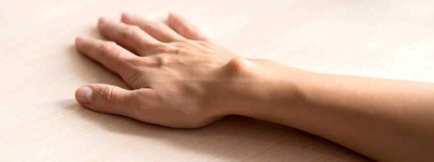 ganglion czym jest jak sie objawia i jak go leczyc