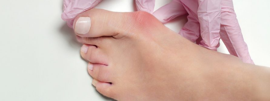 haluksy dlaczego powstaja i jak je leczyc