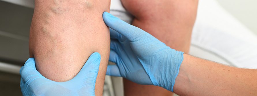 nogi bez zylakow poznaj metode rfitt celon