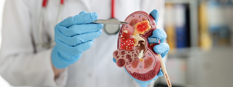 nowoczesne technologie w onkologii rola robotyki chirurgicznej w leczeniu raka nerki kopia