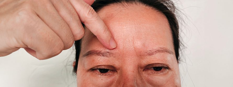 obrzek sluzowaty co to za choroba i jak mozna ja leczyc