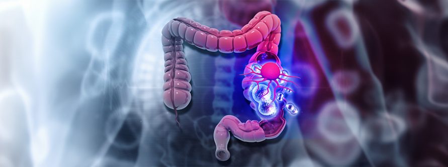 operacyjne leczenie raka jelita grubego